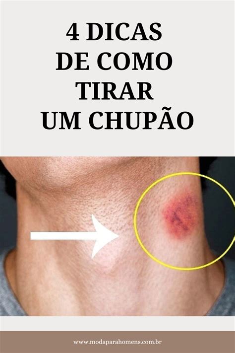 chupão no peito|Como tirar um Chupão: 5 dicas que ajudam rapidamente